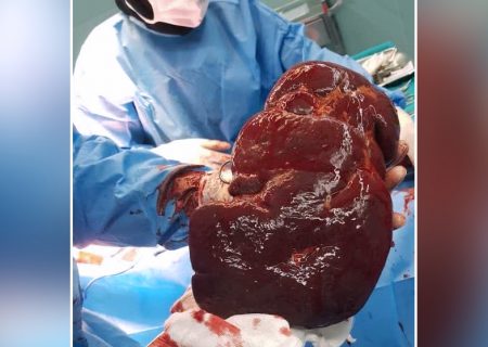 خارج کردن طحال سه کیلویی از بدن یک بیمار در فردیس