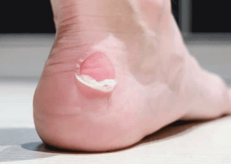 پوست روی تاول پا را نکَنید